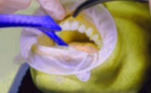 我的拔牙记作文(经典)